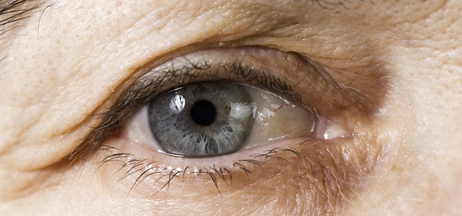 What are the signs of aging around the eye
