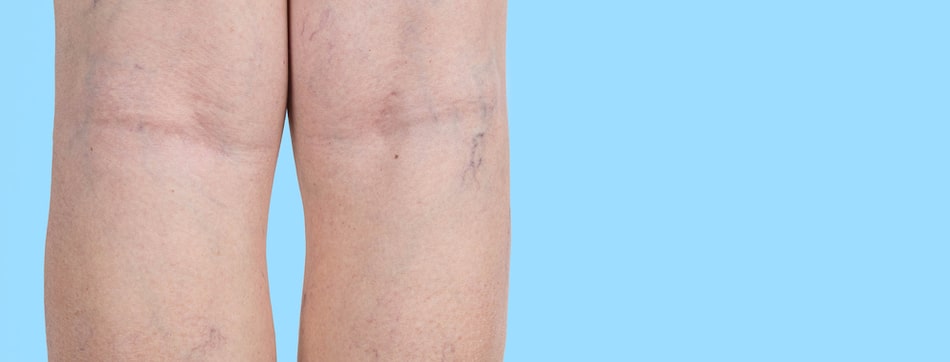 Treatment for spider veins on legs