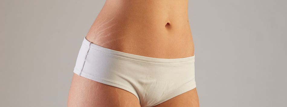 Laser stretch mark removal