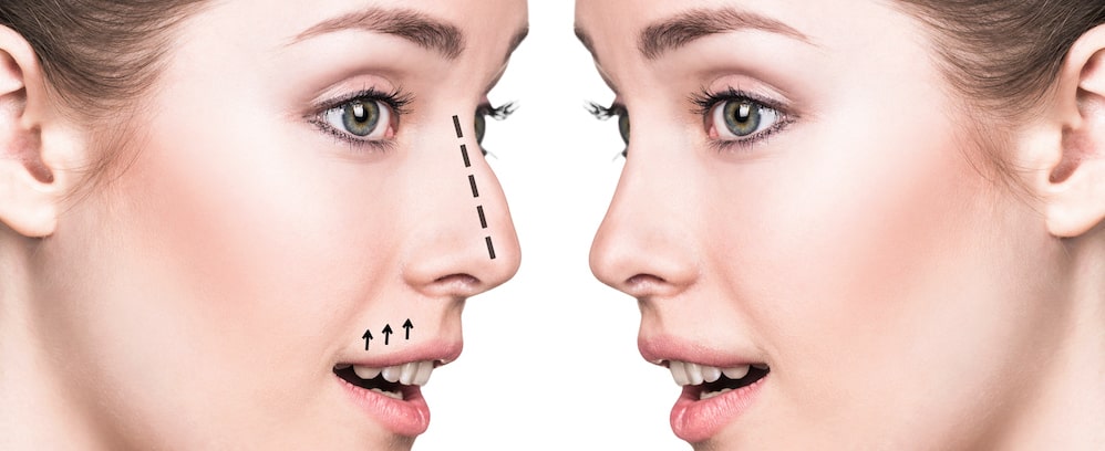 More Teens Want a Nose Job - TikTok to Blame for Rhinoplasty Rise?