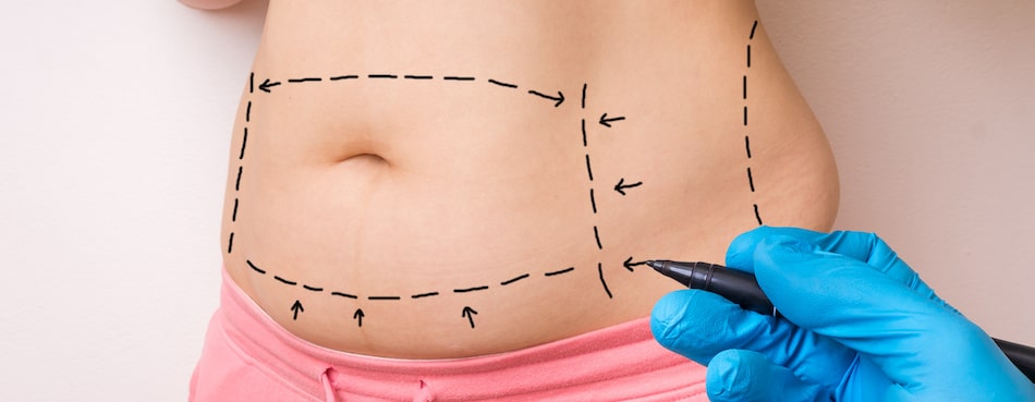 Tummy Tuck - Procedure Explained