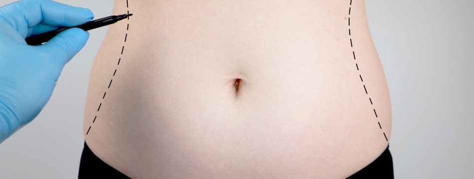 Abdominoplasty health benefits