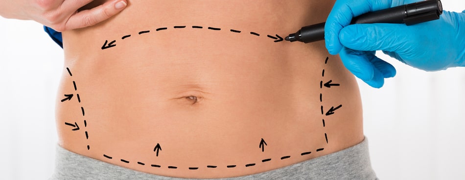 Tummy Tuck - What Can it Do for You?