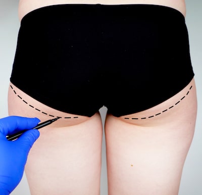 What is butt lift surgery