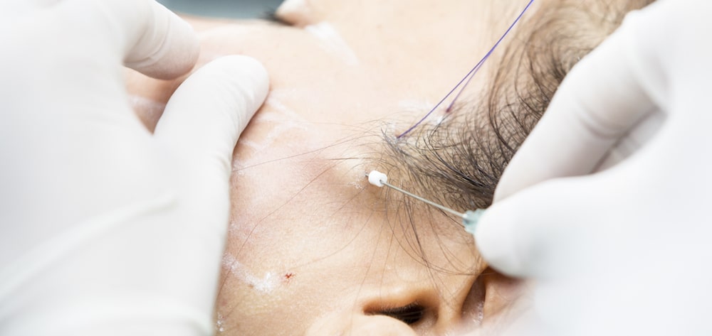 Why are thread lifts a popular procedure