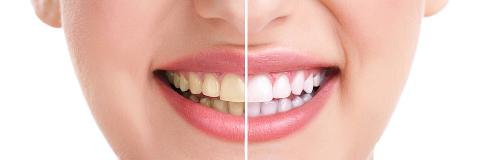 Zoom Teeth Whitening - How to Get a Brighter Smile