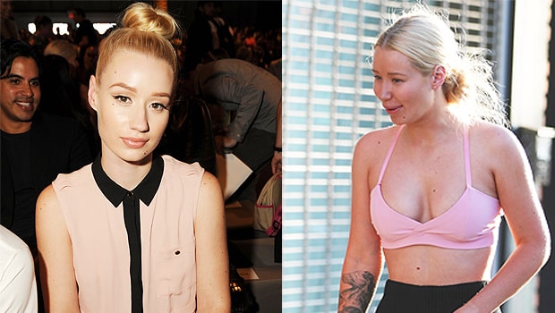 Iggy Azalea Discusses Plastic Surgery